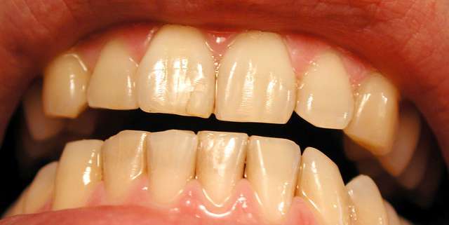 Tooth Color Analysis: Finding the Perfect Match with Spectrophotometers ...