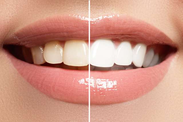 spectrophotometer-tooth-whitening-3.jpg